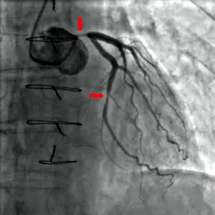 Coronary angiography X-ray image showing a narrowed heart artery