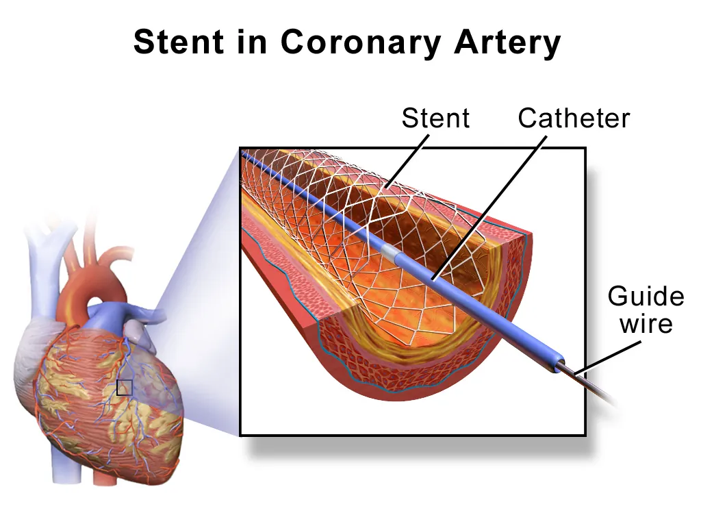 Illustration of coronary angioplasty: a balloon opens a blocked heart artery and a stent keeps it open