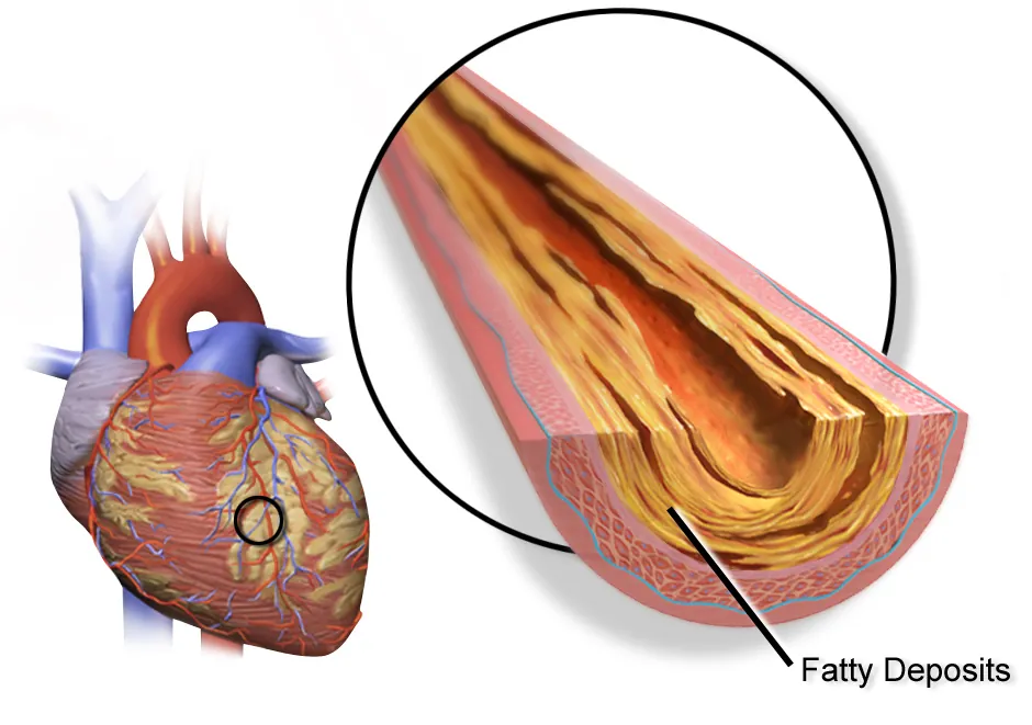 Illustration of hard plaque building up inside a coronary artery
